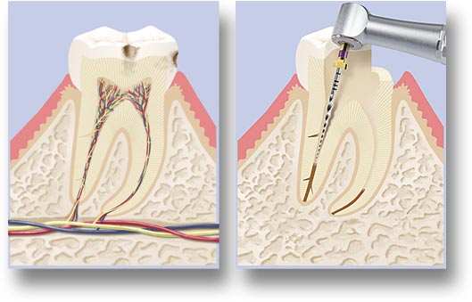 Illustration Endodontie